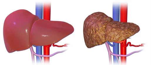 Liver problems
