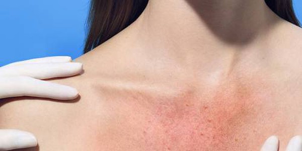 Larocheposay-SubCategory-Sun-Sun-sensitivity-and-sun-reactions Larocheposay-SubCategory-Sun-Sun-sensitivity-and-sun-reactions
