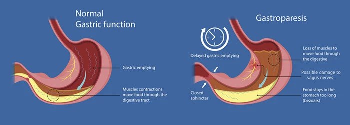 gastroparesis-shutterstock-copy gastroparesis-shutterstock-copy