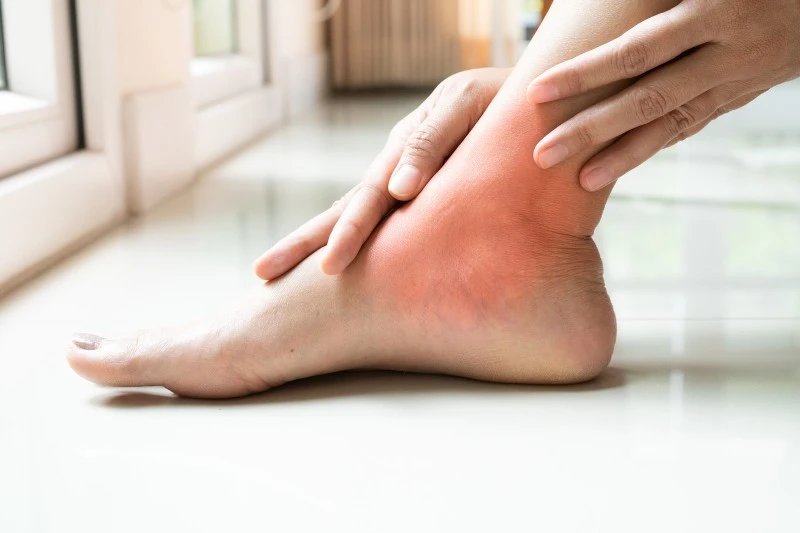 Gout-in-Foot Gout-in-Foot
