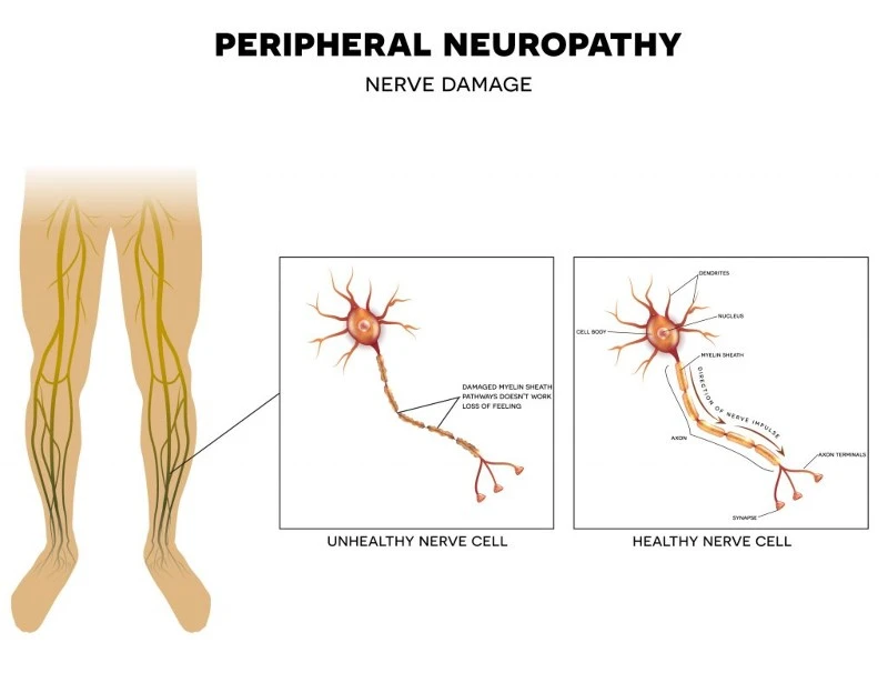 PeripheralNeuropathyImage-1024x799 PeripheralNeuropathyImage-1024x799