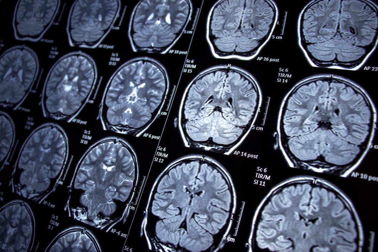 MRI images MRI images