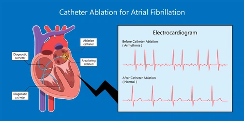 Atrial fibrillation Atrial fibrillation