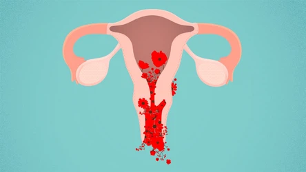 Heavy bleeding Heavy bleeding