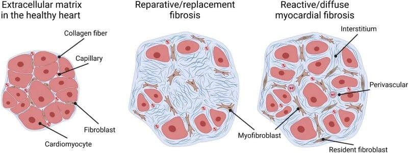 myocardial fibrosis myocardial fibrosis